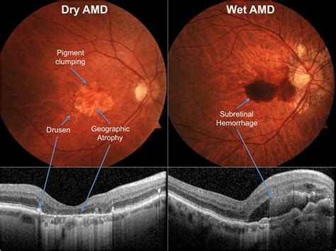 makulato|Macular degeneration